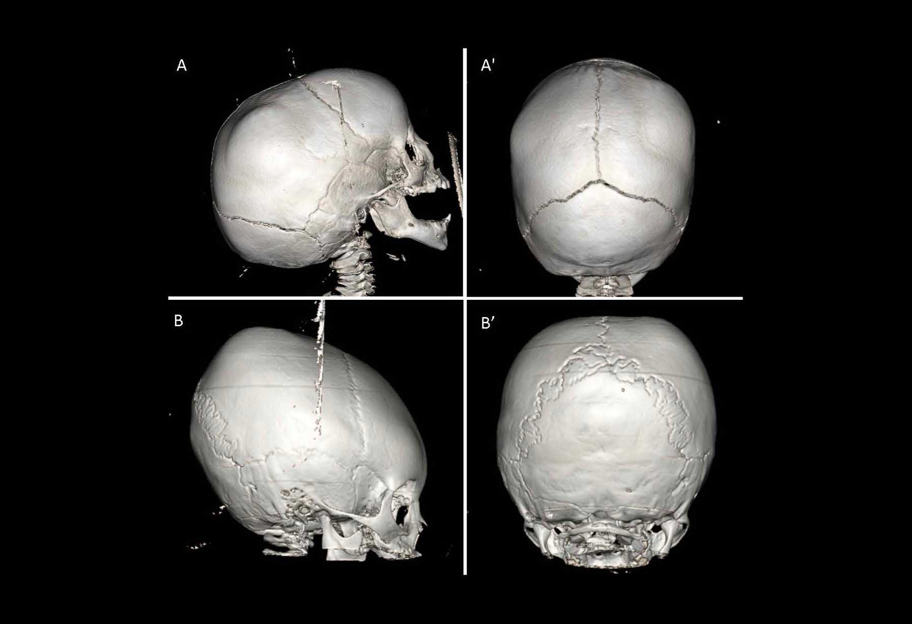 Revolutionizing State-of-the-art 3D-photography to Improve The Evaluation of  Pediatric Cranial Reconstructions