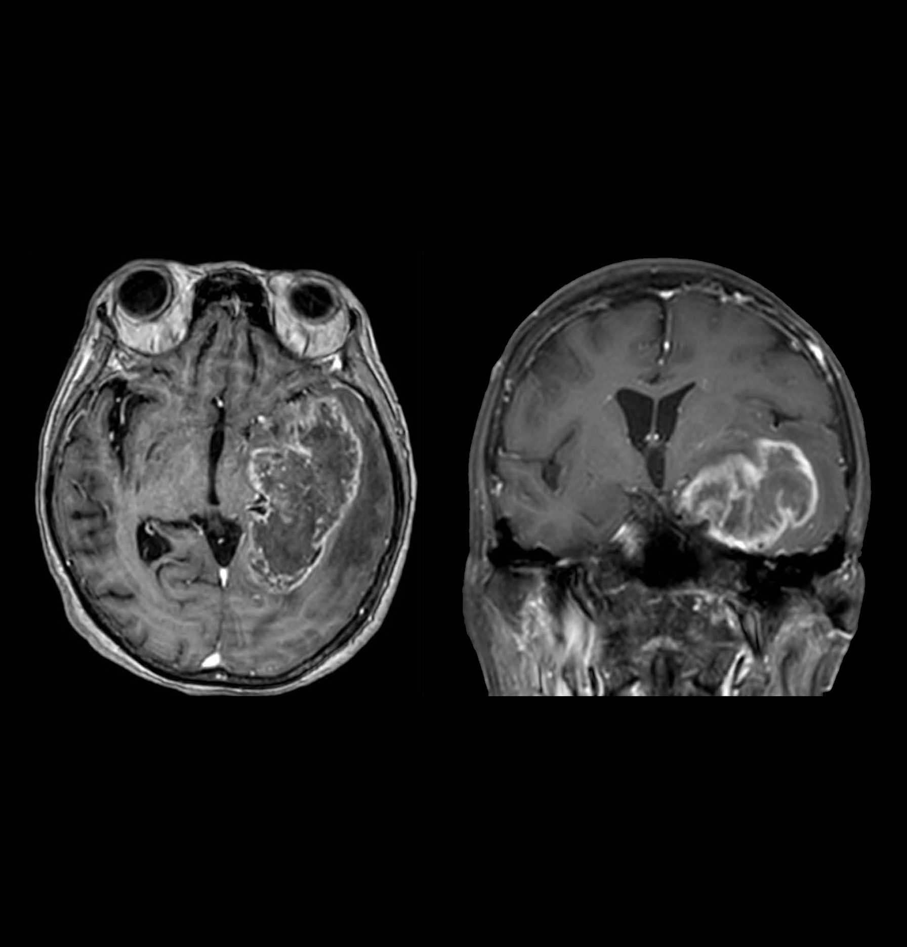 Montefiore Einstein Offering Promising Vaccine Trial for Patients with Newly Diagnosed Glioblastoma