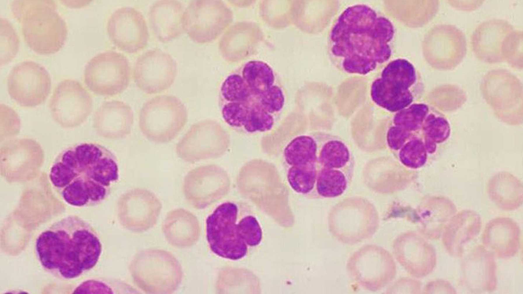 New Treatments Needed for a Deadly Cancer