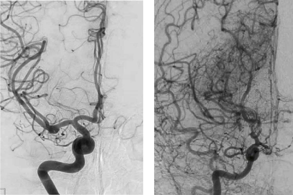  An International Referral Site for the Most Complex Rare Moyamoya Cases