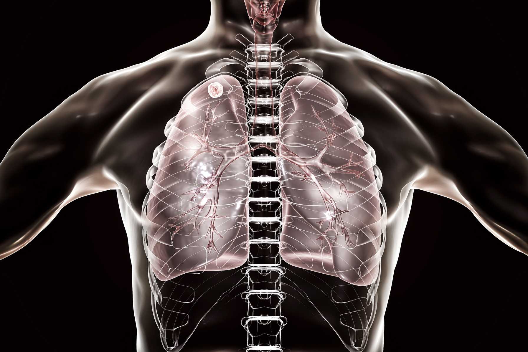 Medical illustration of human lungs showing early-stage lung cancer within a transparent chest view