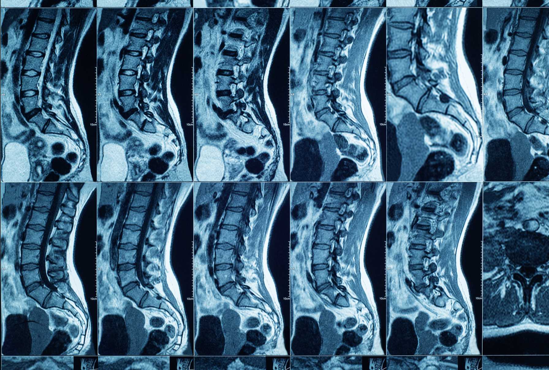 Montefiore Einstein Expands Spine Oncology Care with New Carbon Fiber Implants