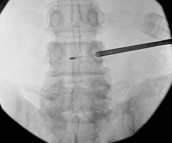 Novel Minimally Invasive Spinal Treatment Offers New Hope for Chronic Low Back Pain