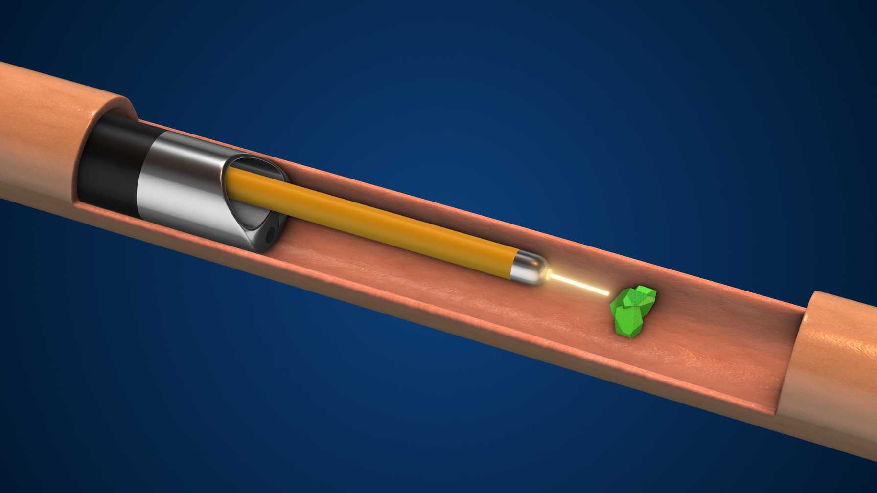 Removing Kidney Stones with New Groundbreaking Technologies