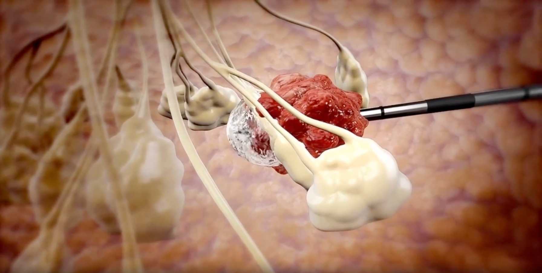 Contributing to the Future of Breast Cancer Care with Cryoablation  