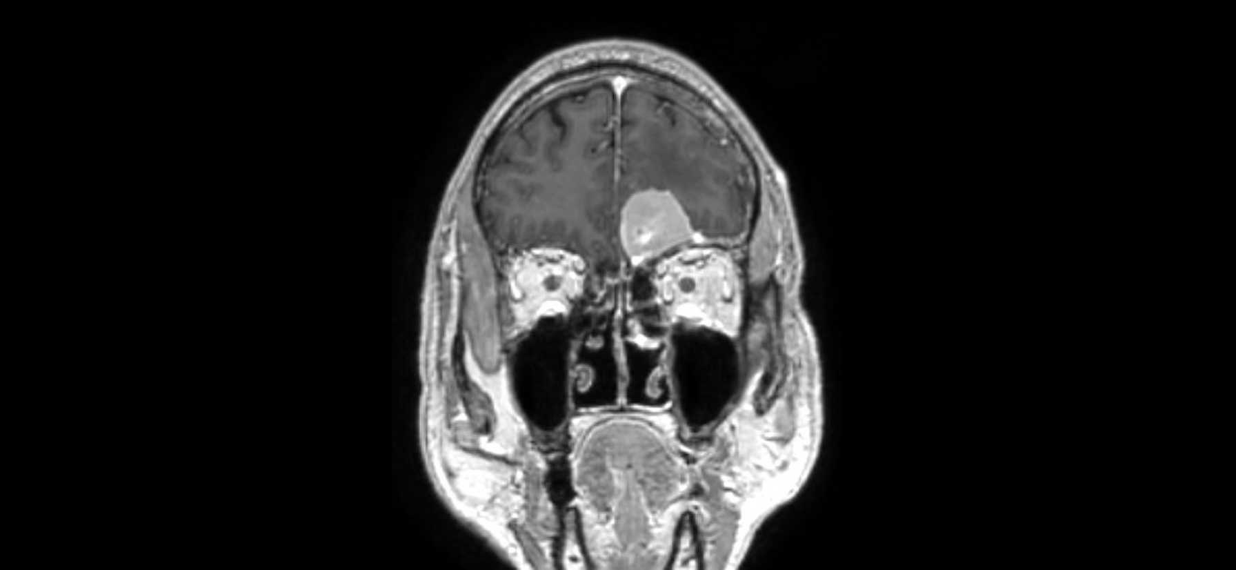Incisionless Brain Tumor Surgery