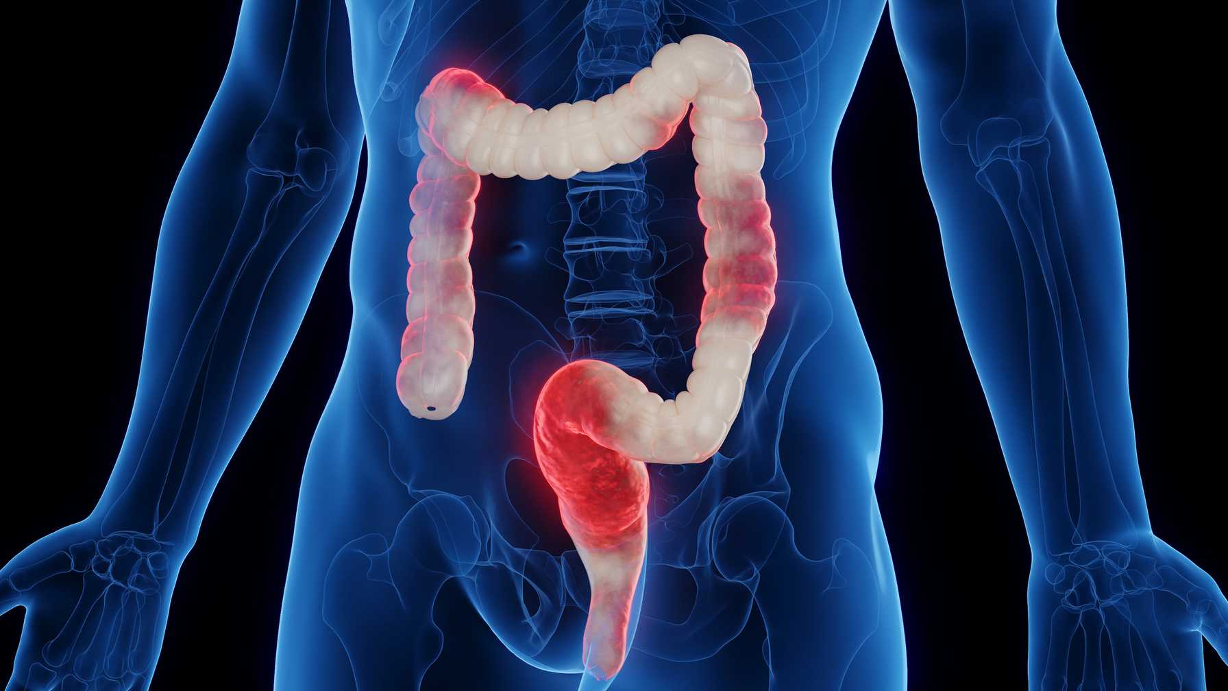 Montefiore Einstein Advances Inflammatory Bowel Disease Care