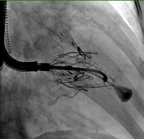 Pioneering a Novel Approach to Tricuspid Valve Treatment Using a Trans-Jugular Vein 