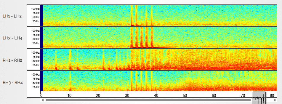  Montefiore Einstein Expands Minimally Invasive Laser Interstitial Thermal Therapy (LITT) Program, Offering New Hope to Children with Drug-Resistant Epilepsy