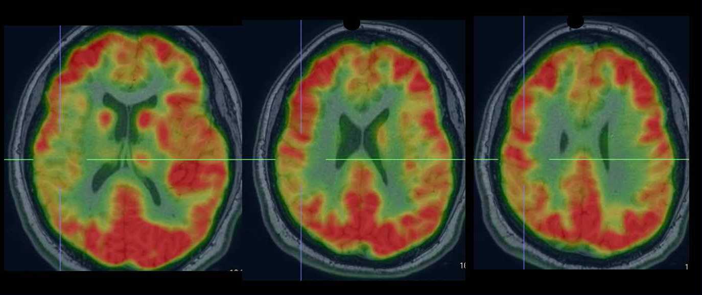 Montefiore Einstein Offering Advanced Treatment for Multifocal and Generalized Epilepsy