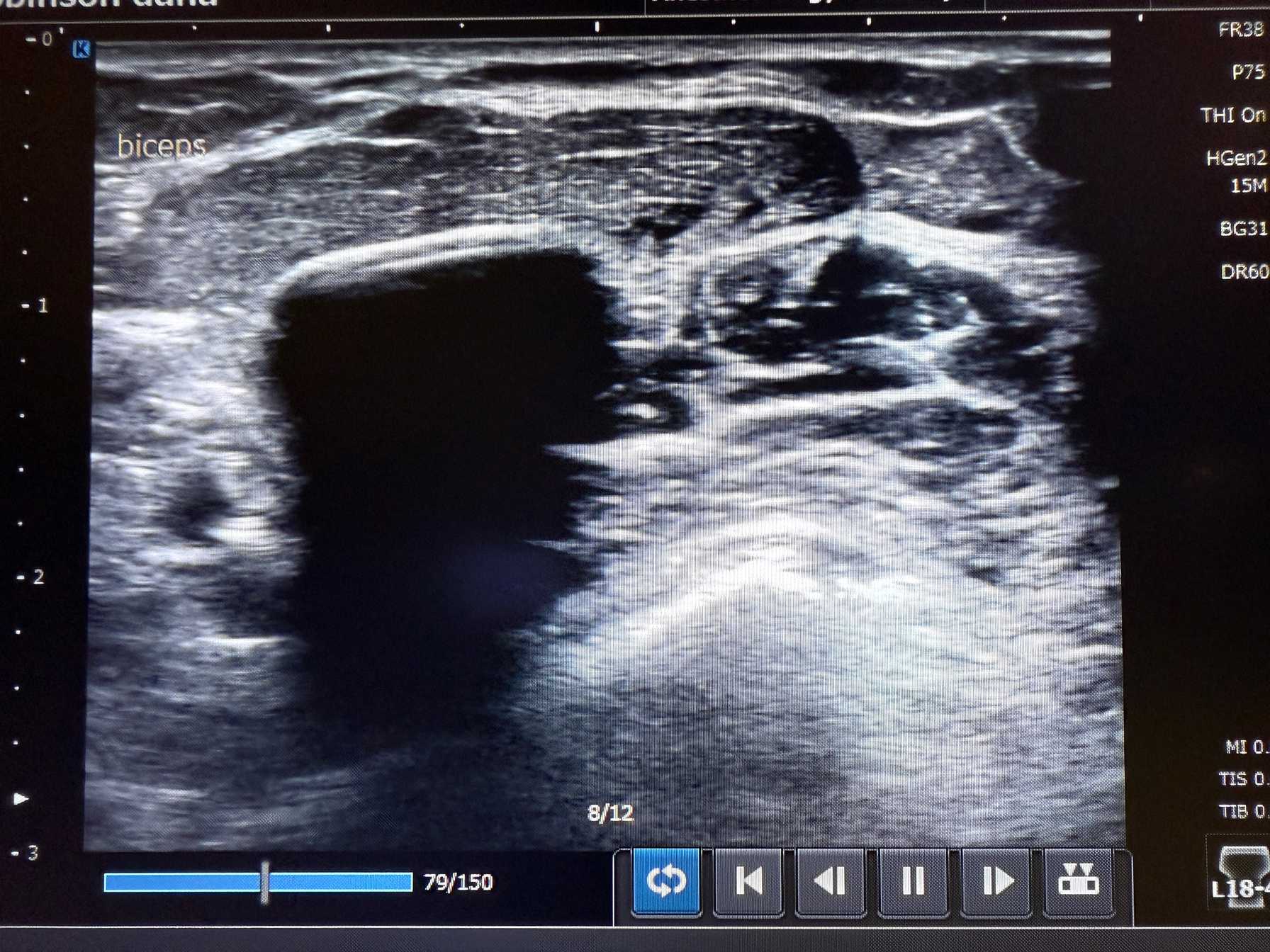Montefiore Einstein’s Department of Physical Medicine & Rehabilitation Pioneers Cryoneurolysis to Freeze Spasticity and Restore Movement