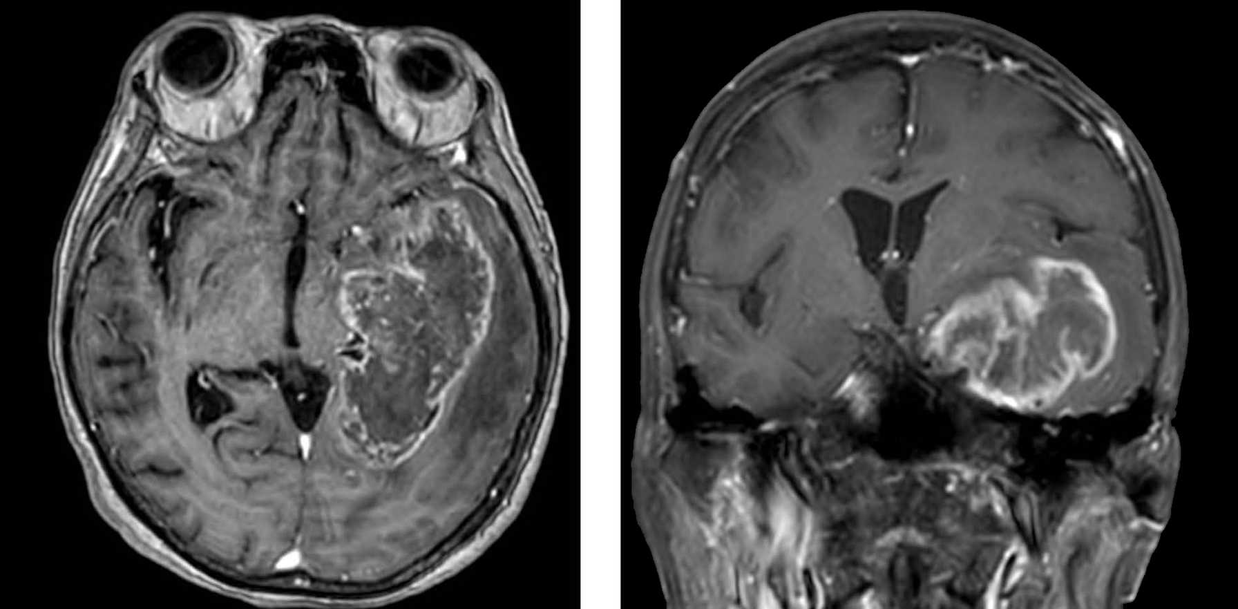 Montefiore Einstein Offering Promising Vaccine Trial for Patients with Newly Diagnosed Glioblastoma