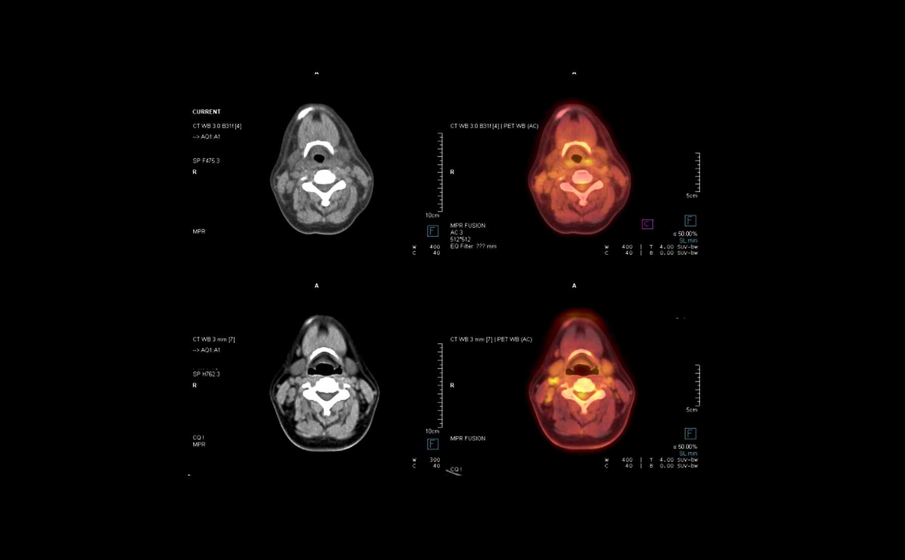 Montefiore Einstein One of Two North American Institutions to Use Intraoperative Cutting-Edge PET-CT Imaging in Head and Neck Cancer Surgery